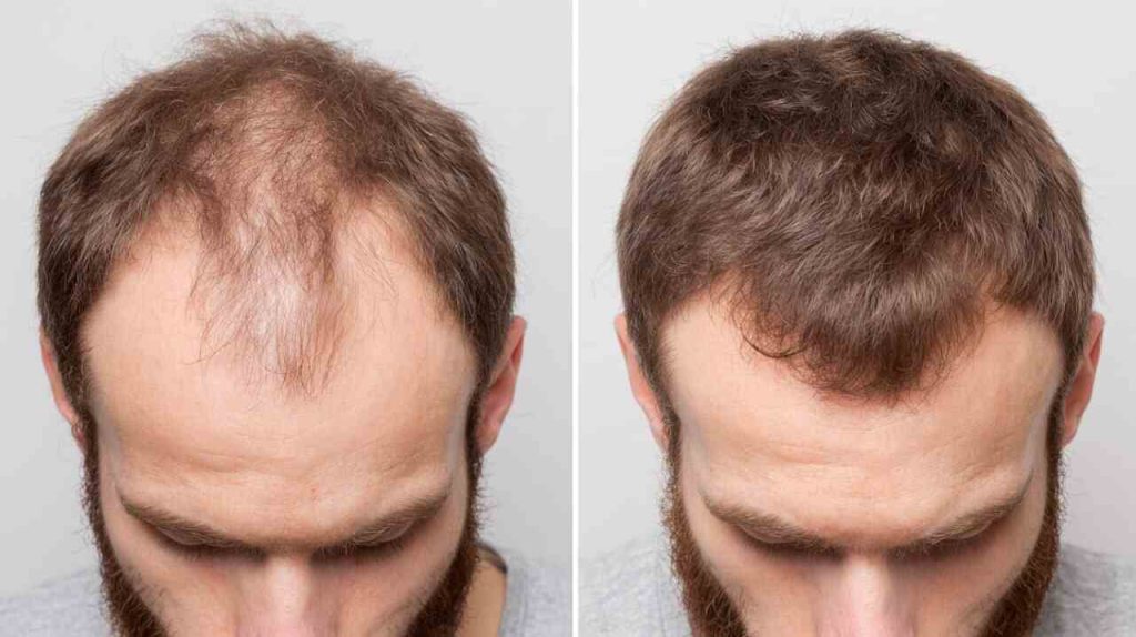 Suffering from hair loss? Thanks to science, you can now regrow in 20 days